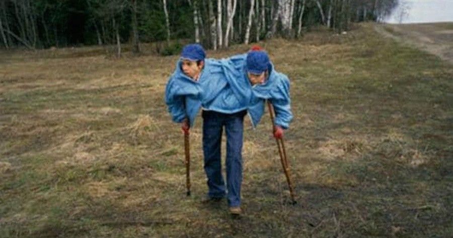 La triste historia de horrores que las gemelas siamesas más viejas del mundo vivieron