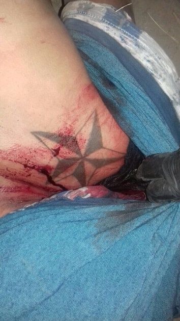 herido2