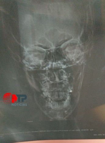 fractura nariz aurrera margarita1