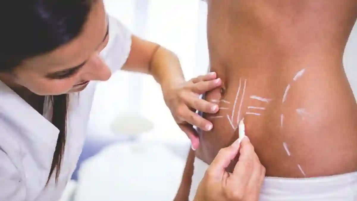 ¿Listo para lucir un abdomen plano en verano_ Consíguelo con cirugía corporal